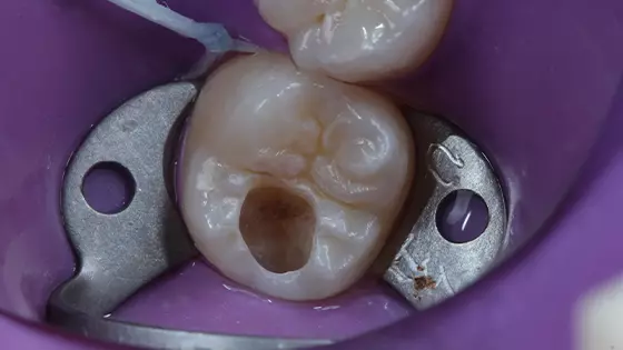Restauração de Resina Composta