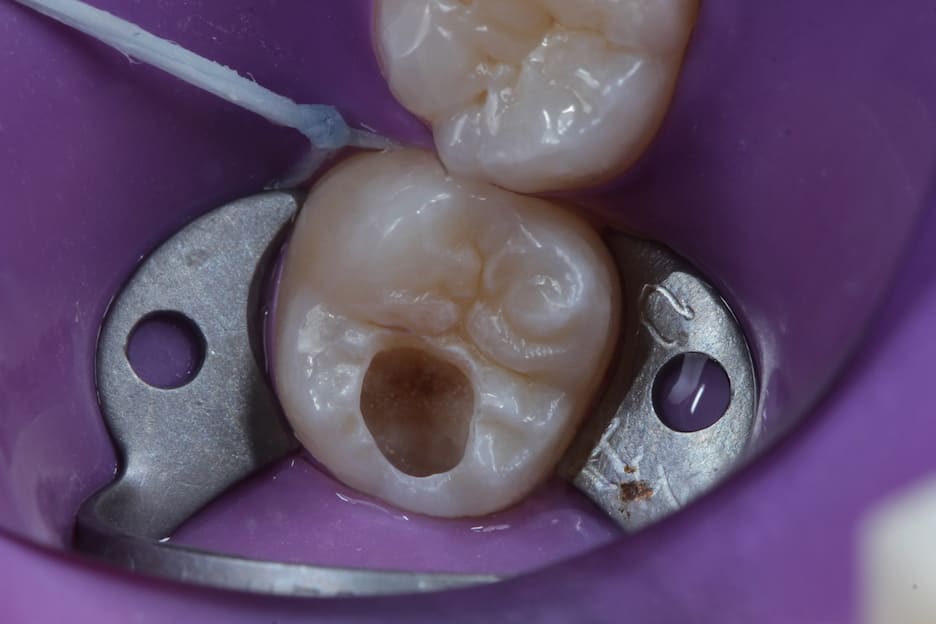 Dente com Carie antes de aplicar a restauração de Resina 