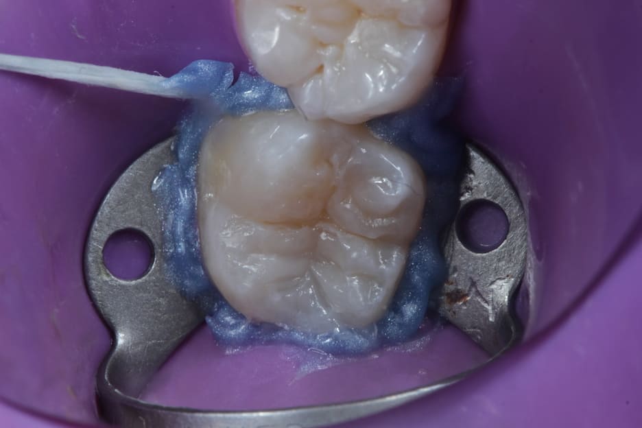 Dente de paciente em Goiânia após a restauração de Resina 