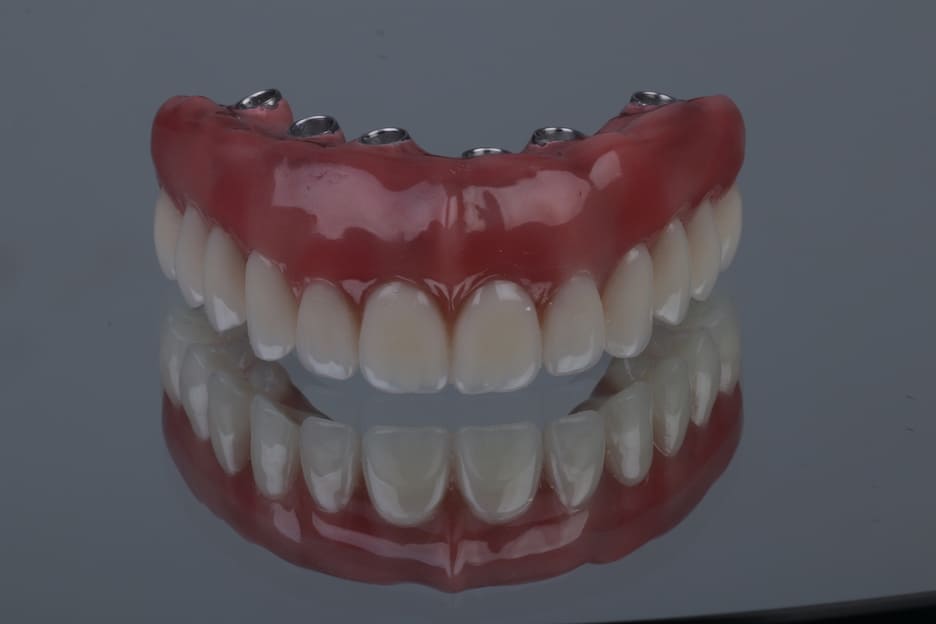 Implante dentário superior de uma paciente da estética Vitae em Goiânia 