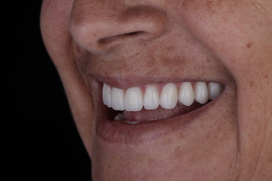 Sorriso de paciente após inserir próteses e implantes em Goiânia 