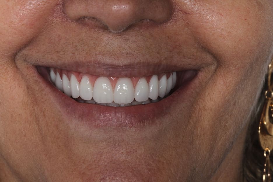 Sorriso lindo da paciente da Estética Vitae após colocar prótese dentária em Goiânia 